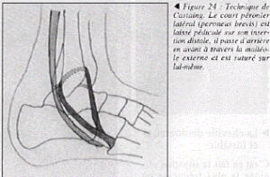Les entorses de Cheville 7