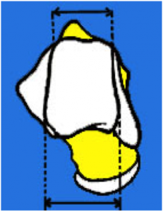 arthrose de la cheville 6