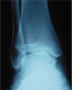 arthrose de la cheville 7